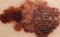 堵住肿瘤的免疫细胞渗漏可以改善皮肤癌的治疗